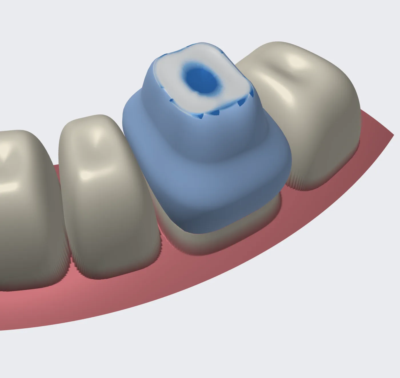 The auto-design draft in the editor: the proposed crown on the prepared lower molar 36, between its neighbours, with the occlusal clearance map on its biting surface.