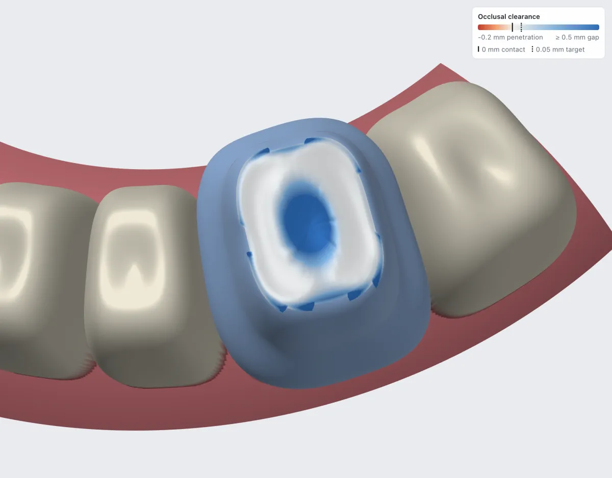 Occlusal clearance colour map on the crown's biting surface, with the editor's legend: 0.2 mm penetration to a 0.5 mm gap, contact and the 0.05 mm target marked.