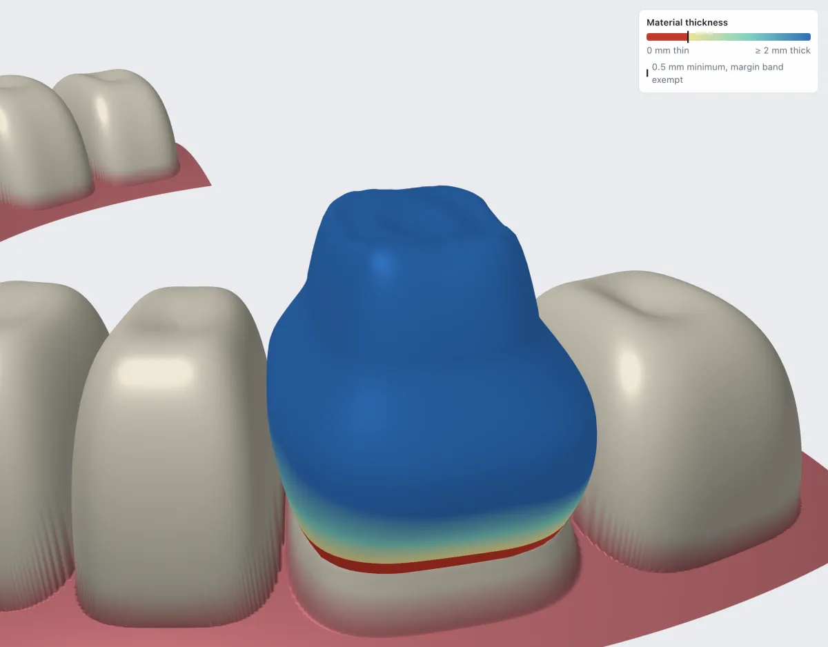 Material thickness colour map on the crown, thin only along the margin band, with the editor's legend from 0 to 2 mm and the 0.5 mm minimum marked.